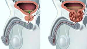Lee más sobre el artículo Hiperplasia Prostática Benigna (HPB): Síntomas y Tratamientos