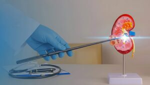 Lee más sobre el artículo Cirugía Láser para Cálculos Renales: 5 Beneficios Clave